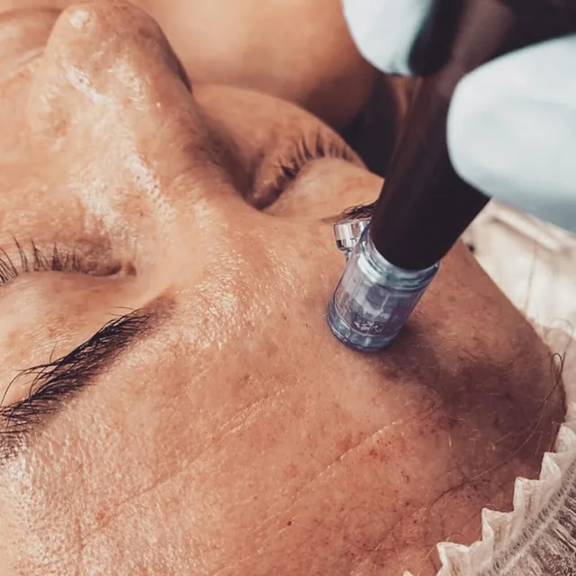 Gros plan d’un dermapen passé sur la peau du front pendant une Skin Needling Therapy